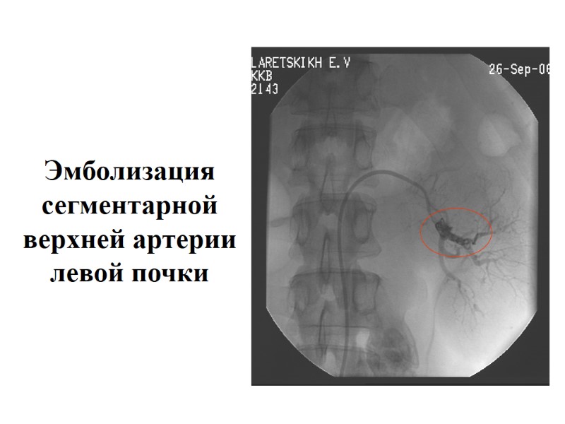 Эмболизация сегментарной верхней артерии левой почки